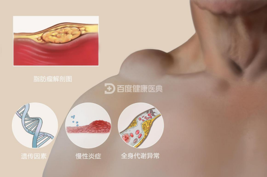脂肪瘤