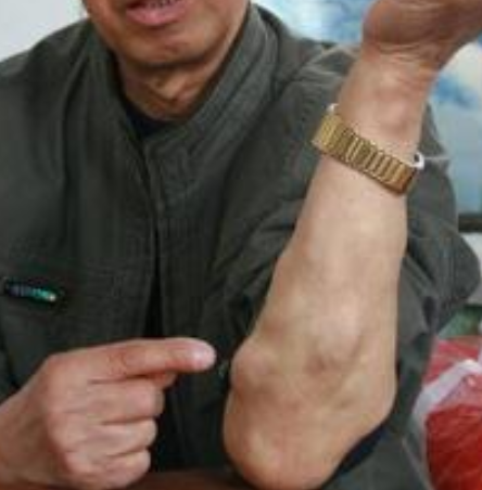 痰核