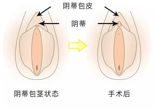阴蒂粘连整形